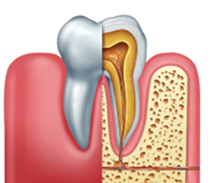 Root Canal Therapy