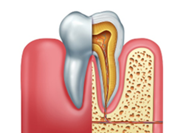 Root Canal Therapy