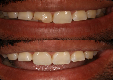 Veneers