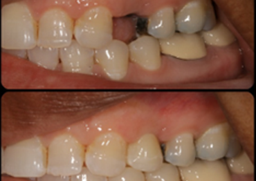 Dental Implants