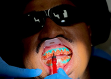 Teeth Whitening