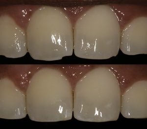 Tooth-Colored Restorations