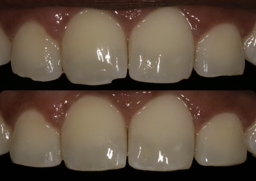 Tooth-Colored Restorations