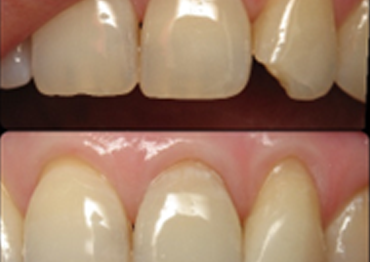 Tooth-Colored Restorations