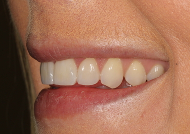 Veneers